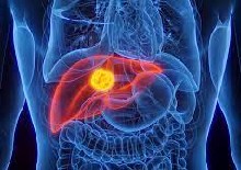 The evolving landscape of precision medicine in primary liver cancer