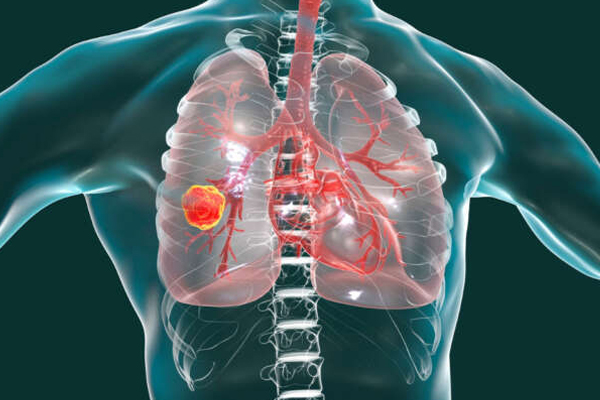 Access to Novel Drugs for Non-Small Cell Lung Cancer in Central and Southeastern Europe: A Central European Cooperative Oncology Group Analysis