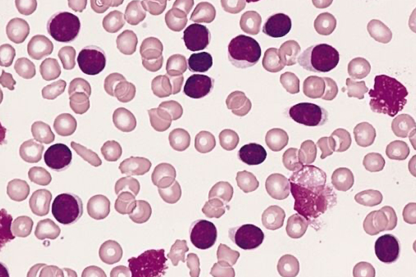 Comparison of Access to Novel Drugs for Lymphoma and Chronic Lymphocytic Leukemia Between India and the United States