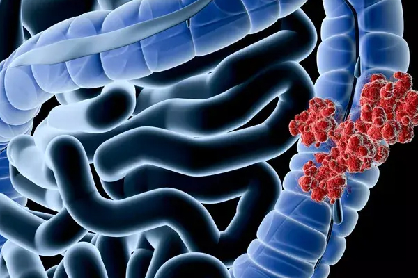 Lessons learnt from scoring adjuvant colon cancer trials and meta-analyses using the ESMO-Magnitude of Clinical Benefit Scale V.1.1